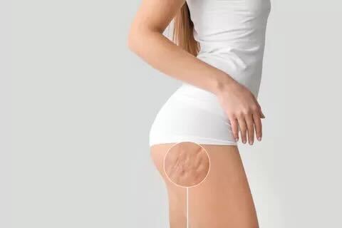 HOW TO GET RID OF CELLULITE WITHOUT SURGERY